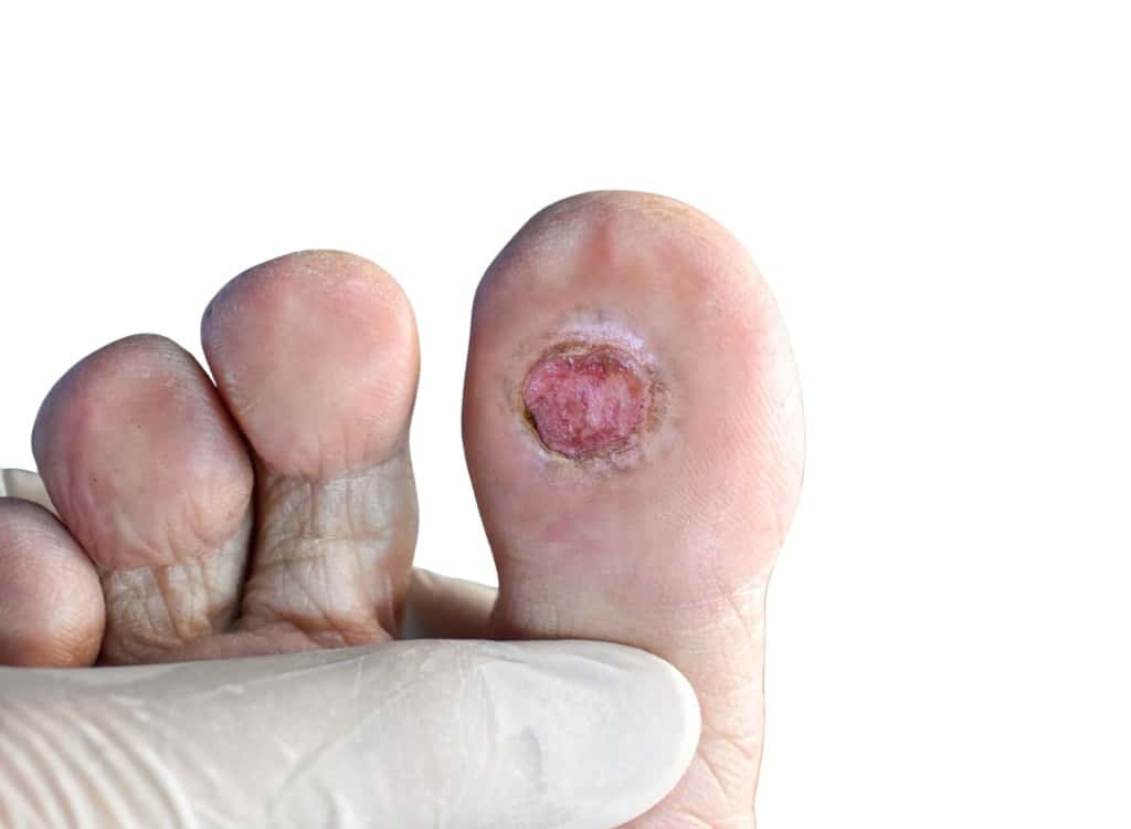 A gloved hand holding a foot with an open ulcer on the sole