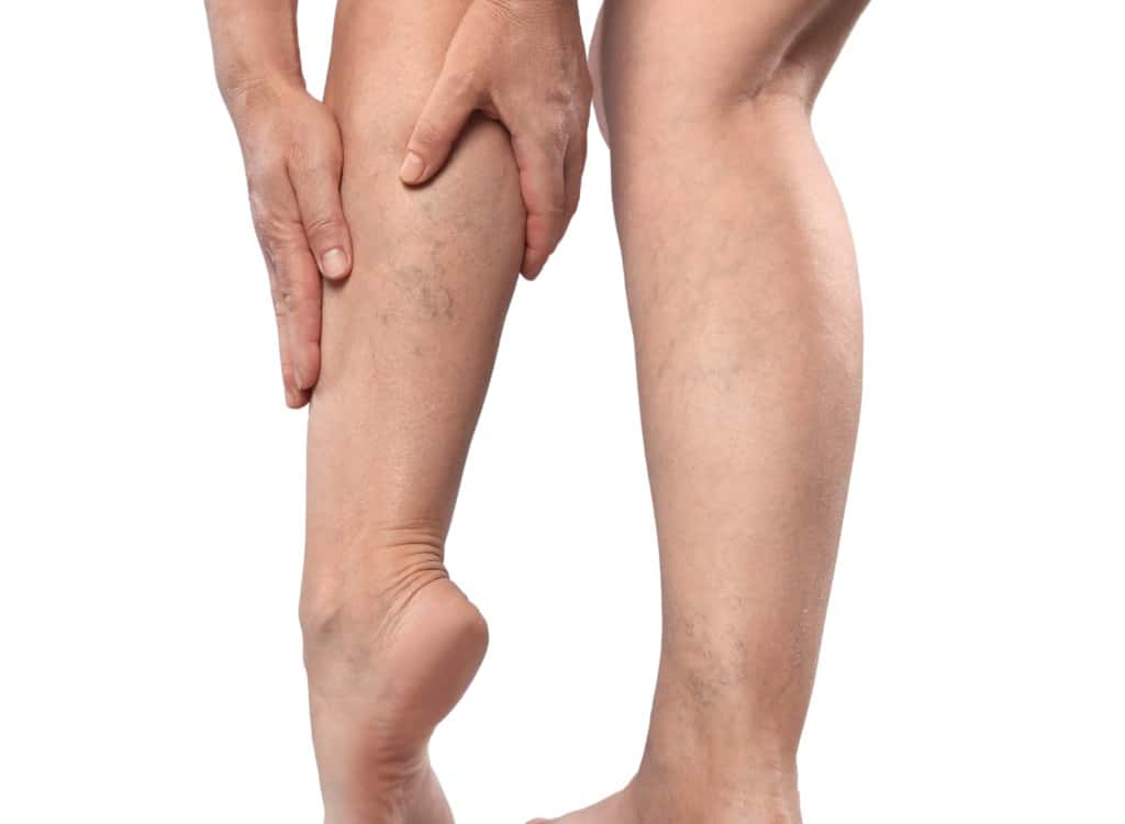 A person holding a lower leg with visible varicose veins