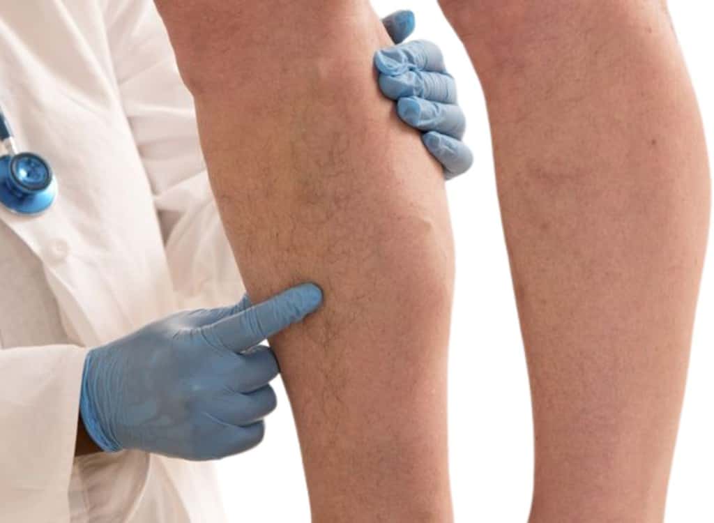 A clinician in gloves pointing to veins on a patient's calf
