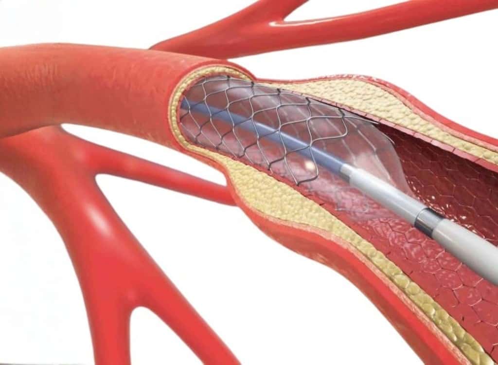 Illustration of a mesh stent expanded inside a cutaway artery