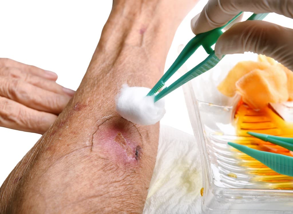 A clinician cleaning an open wound on a lower leg with gauze