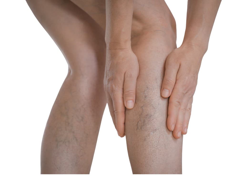 Hands resting on a knee with visible varicose veins